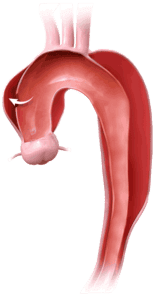 Aortic aneurysm DeBakey Type 1