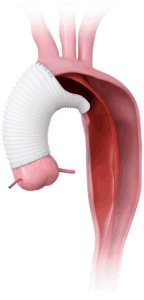 Aortic Hemiarch Repair